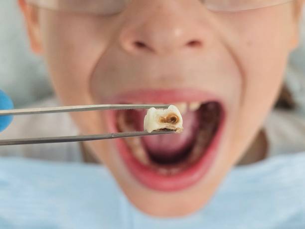 Best Emergency Tooth Extraction in Junction City, CA